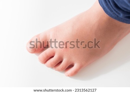The Foot of a kid with insect bite. Fire ant bites