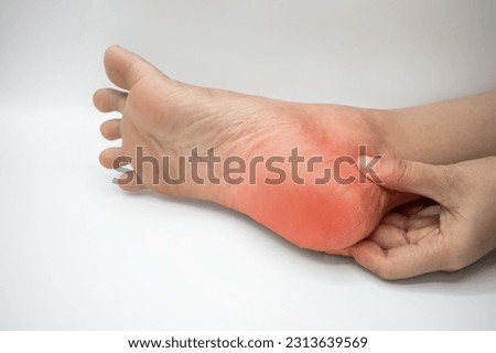 Inflammation at heel of Asian young woman. Concept of foot pain, plantar fasciitis, achilles tendonitis or heel spurs.