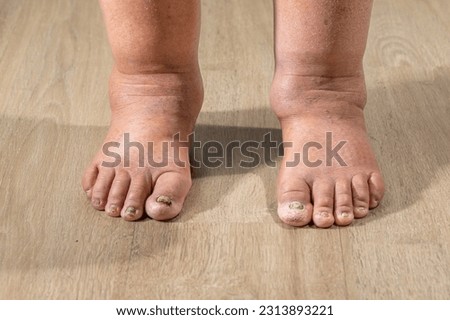 Cancer chemotherapy cause swelling of ankles (ankle oedema) , 
 skin to become dry, dark or peel and nails brittle or flaky. Royalty-Free Stock Photo #2313893221
