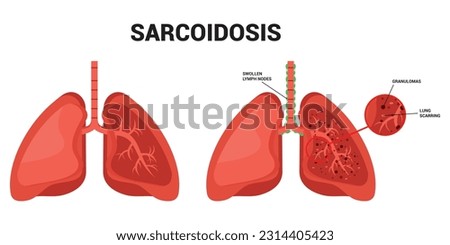 Lung cancer lupus pulmonary fibrosis Sarcoidosis and granuloma amyloidosis tuberculosis Royalty-Free Stock Photo #2314405423