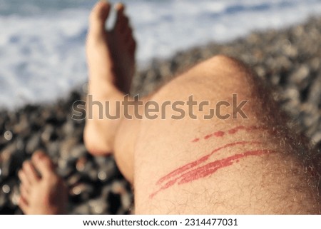 A jellyfish sting burn on a man's leg, on the beach Royalty-Free Stock Photo #2314477031