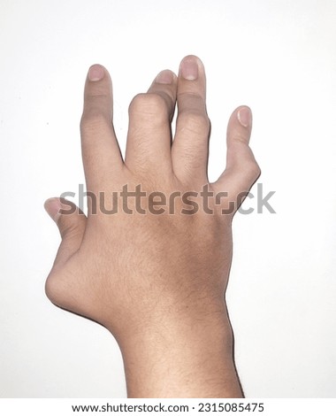 Right hand with impaired joint condition due to juvenile idiopathic arthritis Royalty-Free Stock Photo #2315085475