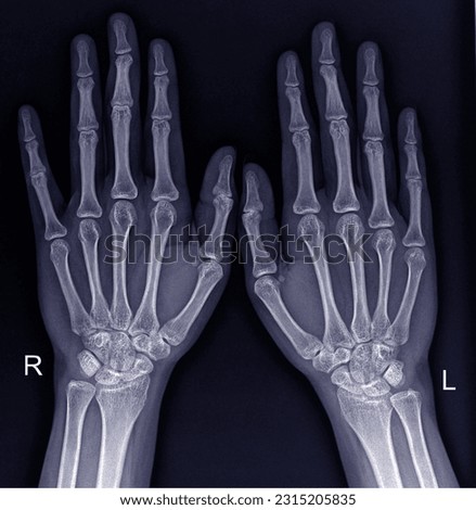 Film X-ray normal both hands 