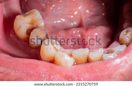 Tooth decay, broken teeth, oral health Poor dental health. Oral health problems. Loose, yellow teeth, plaque and tartar at the edge of the gums Royalty-Free Stock Photo #2315270759