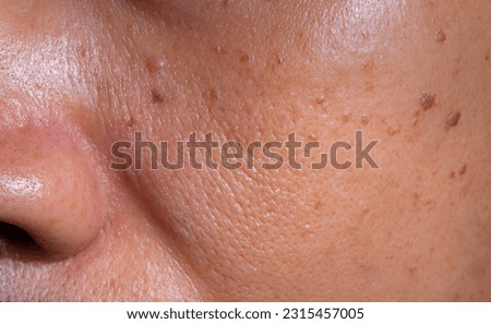 Skin on the face that has deteriorated, large pores, spots, moles, blemishes or acne for the elderly. Facial skin lacks maintenance, dark spots, age deterioration. Royalty-Free Stock Photo #2315457005