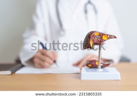 Doctor with human Liver anatomy model. Liver cancer and Tumor, Jaundice, Viral Hepatitis A, B, C, D, E, Cirrhosis, Failure, Enlarged, Hepatic Encephalopathy, Ascites Fluid in Belly and health concept Royalty-Free Stock Photo #2315805335
