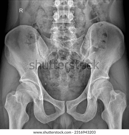 Normal pelvis x-ray imaging q Royalty-Free Stock Photo #2316943203