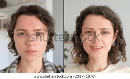Two close up faces of young beautiful woman show real result before and after acne treatment. Split screen. Home background. Concept  of acne therapy, scars, inflammation on face and problem skin. UGC Royalty-Free Stock Photo #2317918769