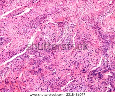 Human ovary carcinoma. Light microscope micrograph of an ovarian malignant adenocarcinoma growing as solid cord masses. Tumor cells show nuclear atypia, giant nuclei and multinucleated cells. Royalty-Free Stock Photo #2318486077