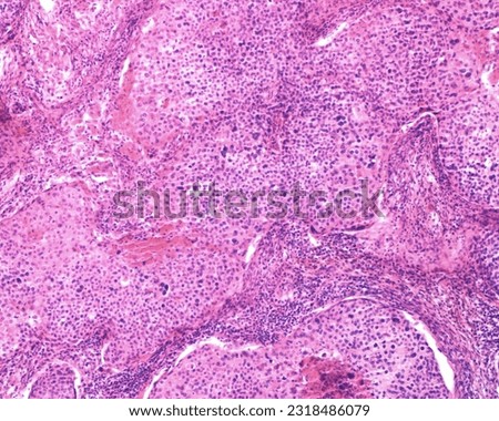 Human ovary carcinoma. Light microscope micrograph of an ovarian malignant adenocarcinoma growing as solid cord masses. Tumor cells show nuclear atypia, giant nuclei and multinucleated cells. Royalty-Free Stock Photo #2318486079