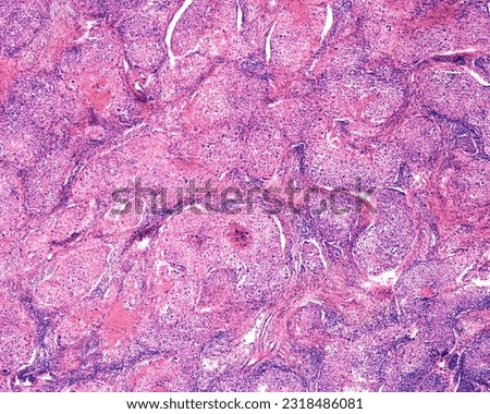 Human ovary carcinoma. Light microscope micrograph of an ovarian malignant adenocarcinoma growing as solid cord masses. Tumor cells show nuclear atypia, giant nuclei and multinucleated cells. Royalty-Free Stock Photo #2318486081