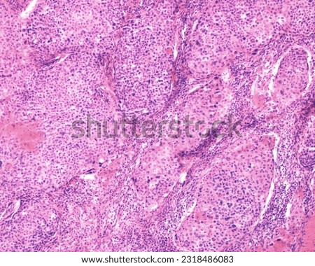 Human ovary carcinoma. Light microscope micrograph of an ovarian malignant adenocarcinoma growing as solid cord masses. Tumor cells show nuclear atypia, giant nuclei and multinucleated cells. Royalty-Free Stock Photo #2318486083