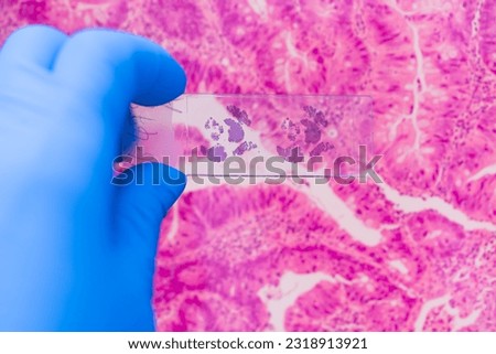 Scientist in blue gloves hand holding glasses slide breast tissue on out of focus cancer tissue picture background.Pathologist hand in glove holding glass organ samples.Histological examination.