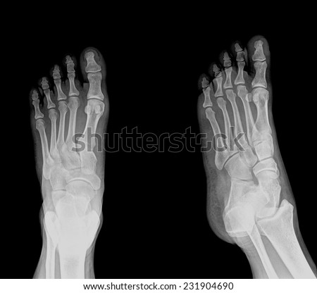 black and white photo of x-ray picture of human foots