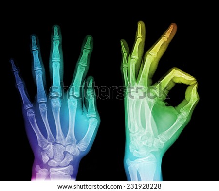 black and white photo of x-ray picture of human hands