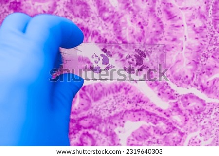Scientist in blue gloves hand holding glasses slide breast tissue on out of focus cancer tissue picture background.Pathologist hand in glove holding glass organ samples.Histological examination.