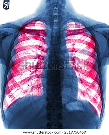 Pulmonary Tuberculosis . Film chest x-ray show fibrosis , interstitial infiltration both lung Royalty-Free Stock Photo #2319750459