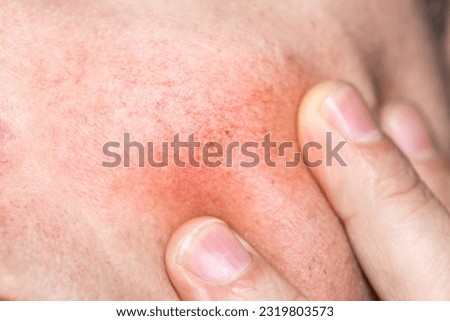Broken capillaries on the face, Red skin problems, Congested skin. The concept of health problems, spider veins, macro, close up Royalty-Free Stock Photo #2319803573