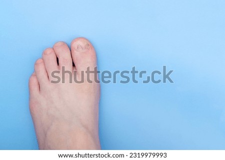 Unibrace system on the leg of a teenager in the treatment of an ingrown nail, On a blue background. Toenail Correction System