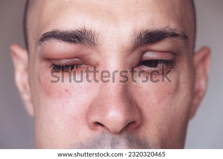Caucasian man has angioedema around the eyes caused by allergic reaction to agents such as insect bites, foods, or medications. Swollen face, close up. Royalty-Free Stock Photo #2320320465