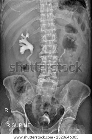 Radiographic image of a real KUB (kidneys, ureters, bladder) X-ray demonstrating the presence of contrast media collecting in the right kidney