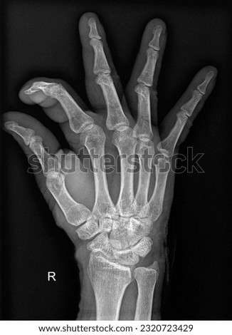 x-ray hand radiograph showing small sign 