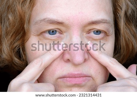 middle aged female's eye with drooping eyelid with patch for eyes. Ptosis is a drooping of the upper eyelid, lazy eye. Cosmetology and facial concept, first wrinkles, closeup Royalty-Free Stock Photo #2321314431