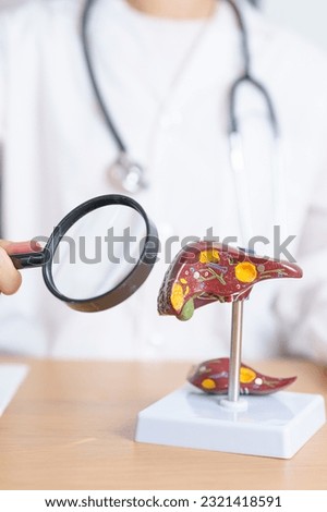 Doctor with human Liver model and Magnifying glass. Liver cancer and Tumor, Jaundice, Viral Hepatitis A, B, C, D, E, Cirrhosis, Failure, Enlarged, Hepatic Encephalopathy and Ascites Fluid in Belly Royalty-Free Stock Photo #2321418591