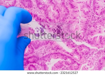 Scientist in blue gloves hand holding glasses slide breast tissue on out of focus cancer tissue picture background.Pathologist hand in glove holding glass organ samples.Histological examination.