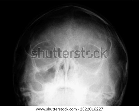 Child's sinus X-ray. shows infection and inflammation in frontal sinus, ethmoid sinus, maxillary sinus and blank area
