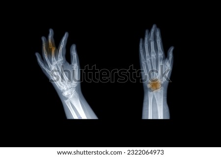 Human adult female hand bones x-ray image. Medical and anatomy radiography or imagery. X-ray picture of hand.