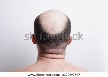 Bald head close-up. The problem of hair loss in men. Alopecia in men. Royalty-Free Stock Photo #2322697567