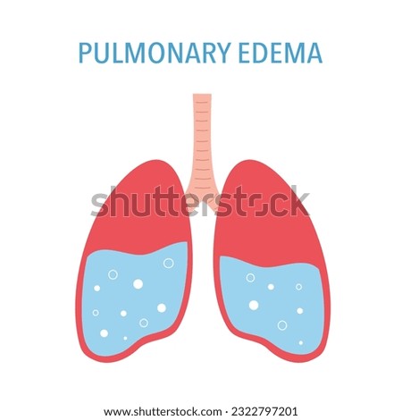 Pulmonary edema lung disease concept vector illustration on white background. Royalty-Free Stock Photo #2322797201