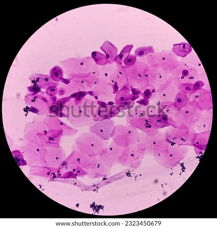 Pap's smear. Inflammatory smear with HPV related changes. Cervical cancer. SCC.