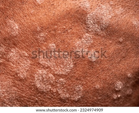 Close-up view of fungal infection of scalp hair. Tinea capitis, ringworm or herpes tonsurans infection. Royalty-Free Stock Photo #2324974909