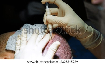 Hair transplant - grafts are held with a stapler. Dhi - Fue  Royalty-Free Stock Photo #2325345939