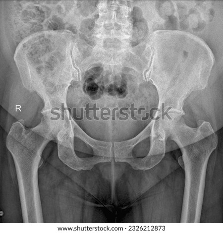 Female Pelvic Bone Imaging AP View  Royalty-Free Stock Photo #2326212873