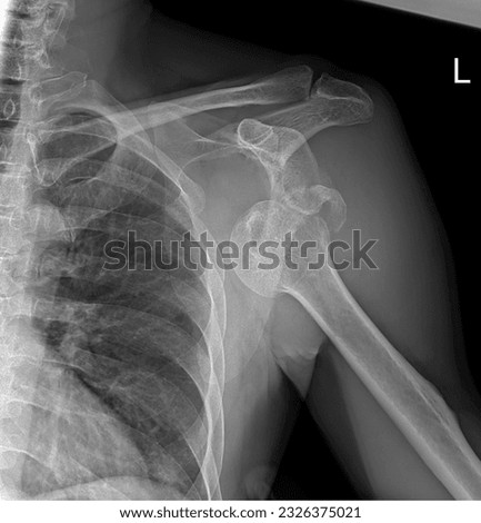 Anterior-posterior X-ray showing the dislocated left glenohumeral joint Royalty-Free Stock Photo #2326375021