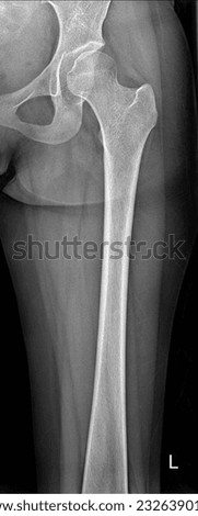 Normal Real X ray of Femur  Royalty-Free Stock Photo #2326390115