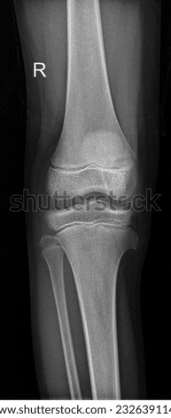 Child knee joint x-ray  showing distal femur tibia and fibula  Royalty-Free Stock Photo #2326391141
