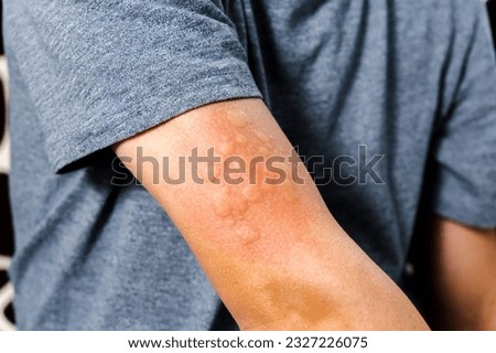 Red rash on skin from allergic reactions. Health care and medical concept, selective focus Royalty-Free Stock Photo #2327226075