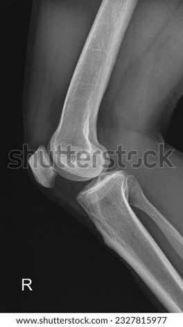 X-ray of the human knee joint, offering a detailed look at the patella, femur, tibia, and fibula. Royalty-Free Stock Photo #2327815977