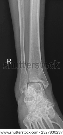 Detailed X-ray image of the human ankle and foot, showcasing the talus, calcaneus, metatarsals, and phalanges, aiding in the assessment of foot and ankle conditions.