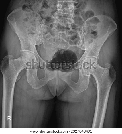 Precise X-ray of the human hip and pelvis, showcasing the acetabulum, femoral head, ilium, ischium, and pubis, aiding in hip-related diagnoses. Royalty-Free Stock Photo #2327843491