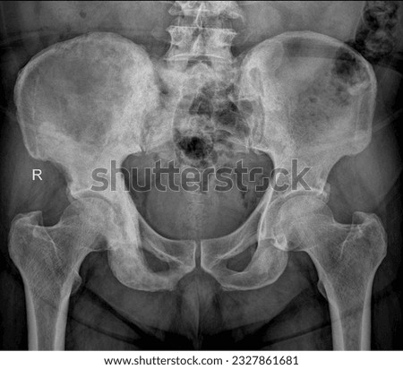  X-ray image of the human pelvis, displaying the ilium, ischium, pubis, and sacrum, aiding in evaluating pelvic fractures and abnormalities. Royalty-Free Stock Photo #2327861681