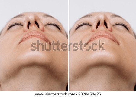 A close-up of woman's nose before and after rhinoplasty on gray background. The result of cosmetic plastic surgery on the nose. Bottom view. Correction of the nasal septum. Beauty concept Royalty-Free Stock Photo #2328458425