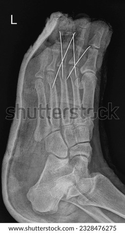Orthopedic X-ray of Ankle and Foot Fracture Royalty-Free Stock Photo #2328476275