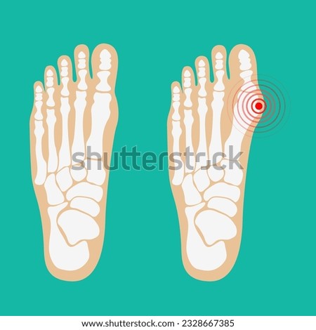 Valgus deformity of the big toe. Foot health care. Vector illustrations. Royalty-Free Stock Photo #2328667385