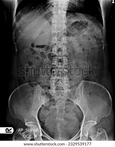 X-ray abdomen AP (antero-posterior radiography)