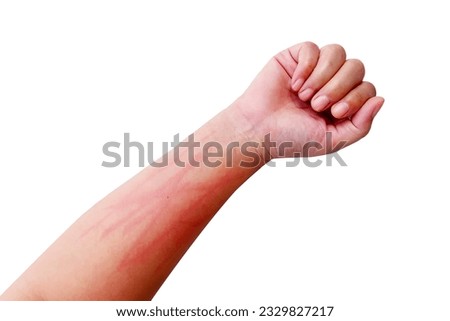 Chronic urticaria or Delayed Pressure Urticaria on the arm, isolate, white background Royalty-Free Stock Photo #2329827217